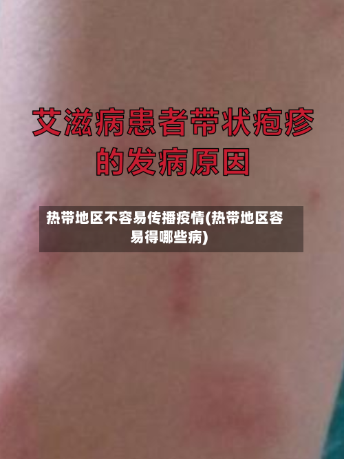热带地区不容易传播疫情(热带地区容易得哪些病)-第2张图片